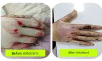 Researchers of Guilan University of Medical Sciences Burns and Reconstructive Medicine Research Center for the first time in the country succeeded in inventing and using two advanced methods of mitotherapy and SVF therapy in burn surgery and wound healing
